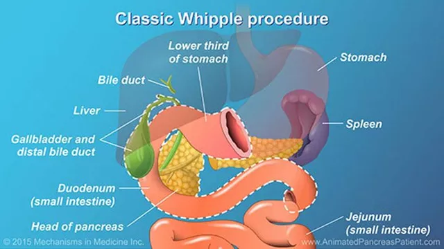 The Benefits of Pancrelipase for Post-Whipple Surgery Patients